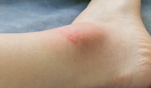 Swollen and red ankle after mosquito bite