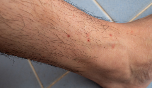 leg flea bite
