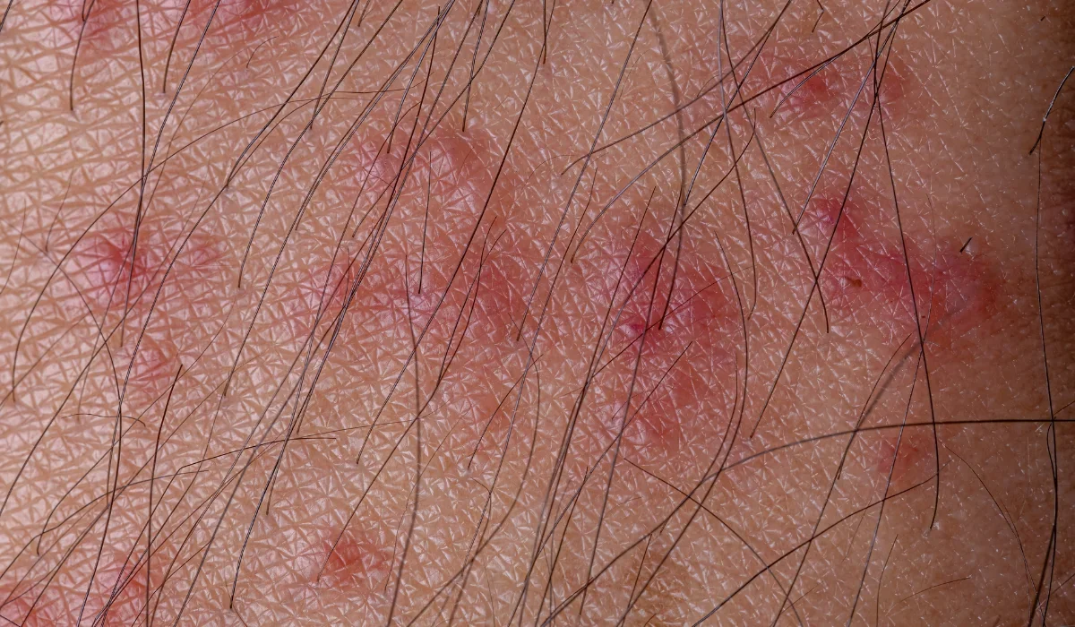 tick bite
